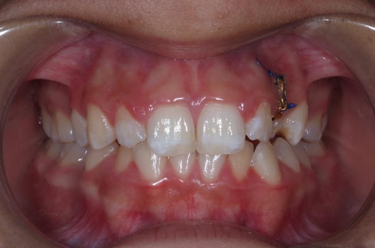 Exposing & Bonding of Brackets to Teeth Explanation & Warnings5